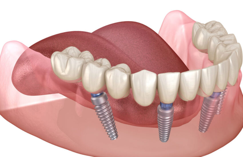 Advancements in All-on-4 Dental Implants: Enhancing Smiles with Innovation