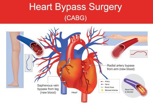 Heart bypass surgery cost in India