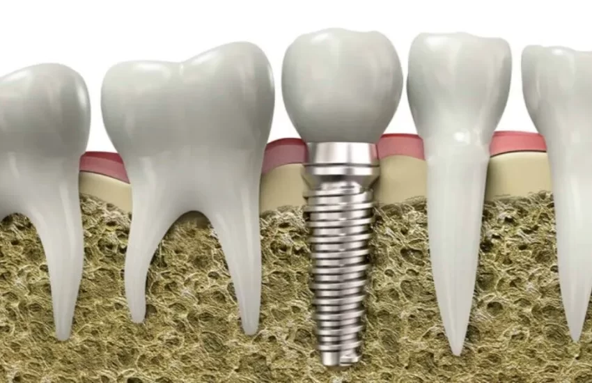 Dental Implant Cost Monroe La
