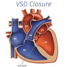 VSD Closure Surgery in India
