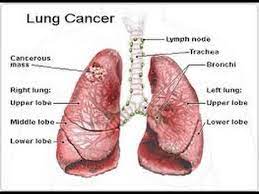 lung cancer treatment cost in India