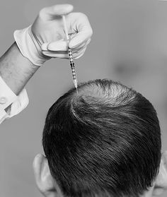 FUE Hair Transplant in Islamabad