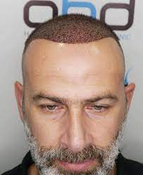 FUE Hair Transplant in Islamabad